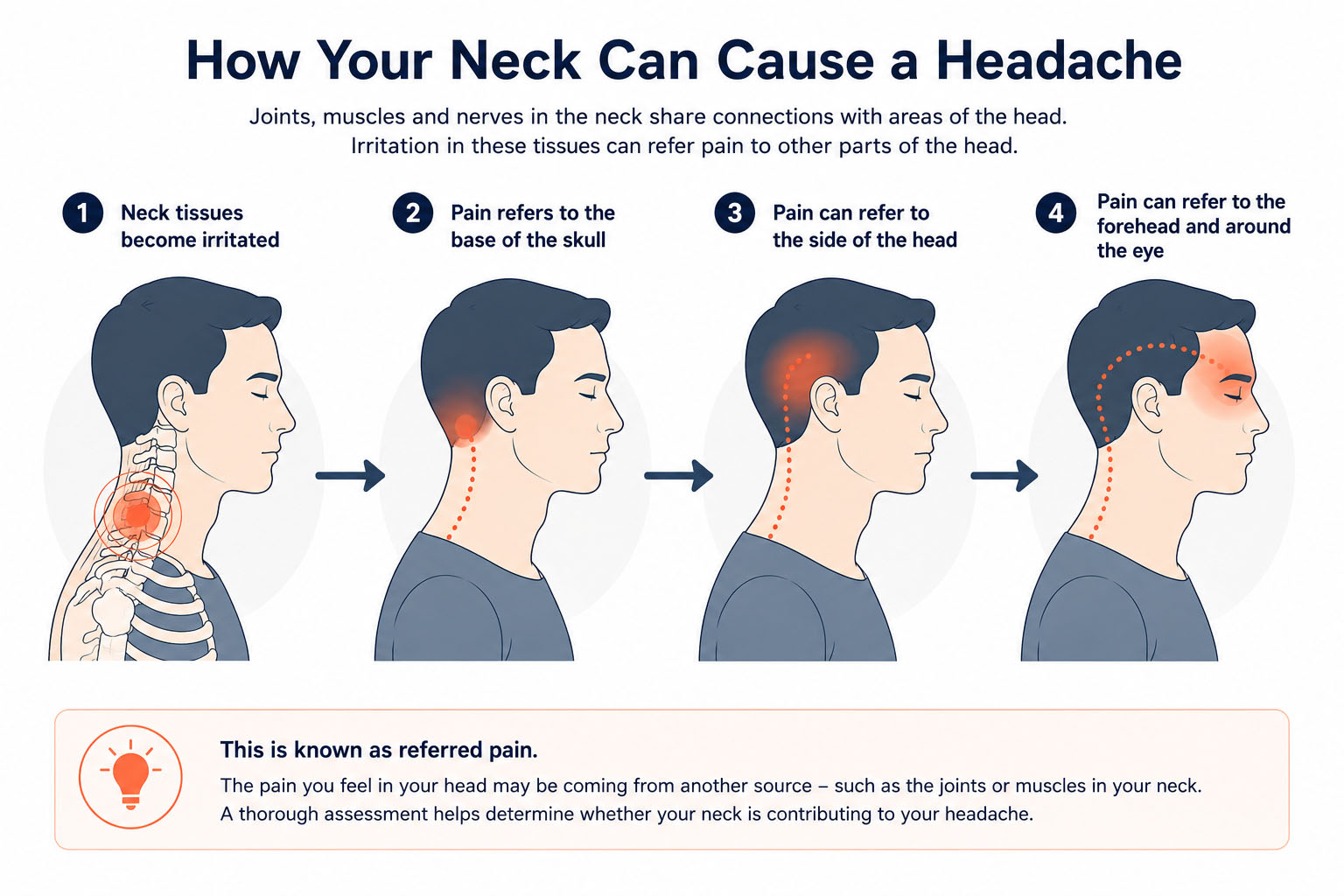 Diagram showing how pain from neck tissues can refer to the base of the skull, side of the head, forehead and eye